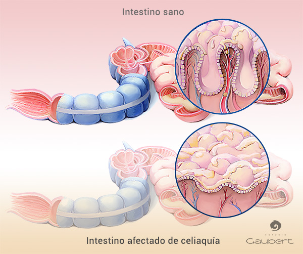 Ilustracion intestino normal y celiaco