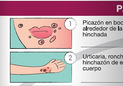 Protocolo de actuación ante una reacción alérgica en la escuela